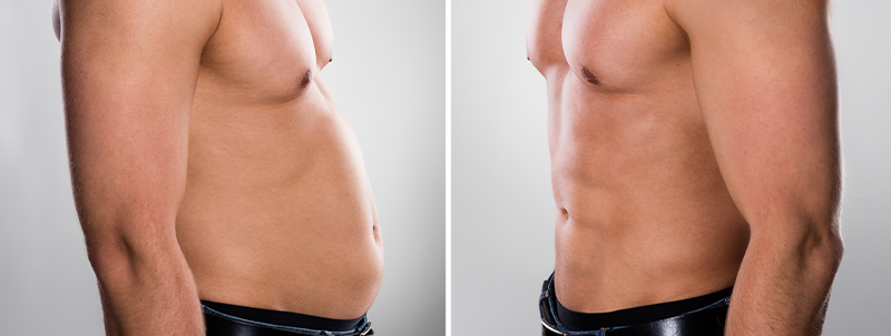 abdominoplatika muži