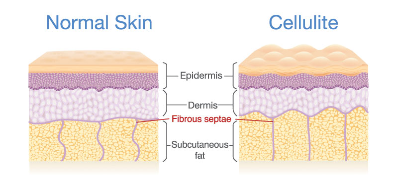 Cellulite