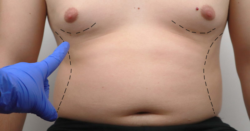 Plastika břicha muži