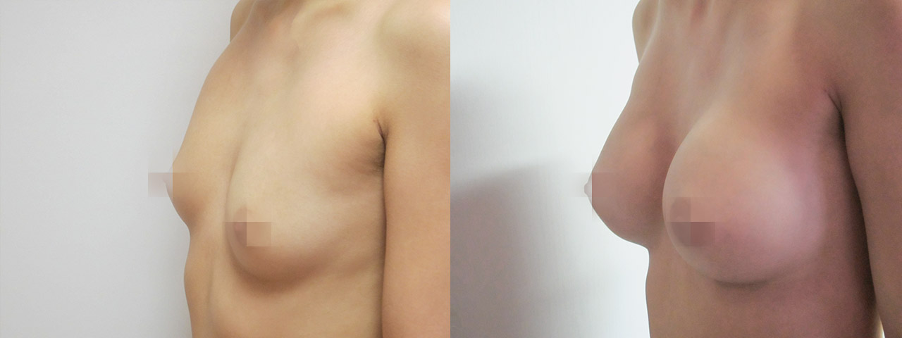 Zvětšení prsou implantáty