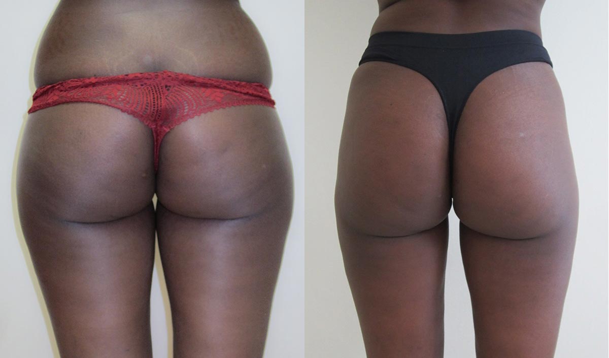 Fotografie před a po - Liposukce stehen a boků.