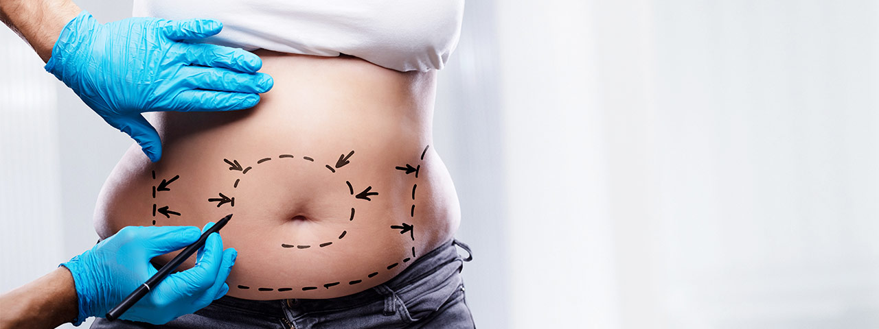 Liposukce břicha