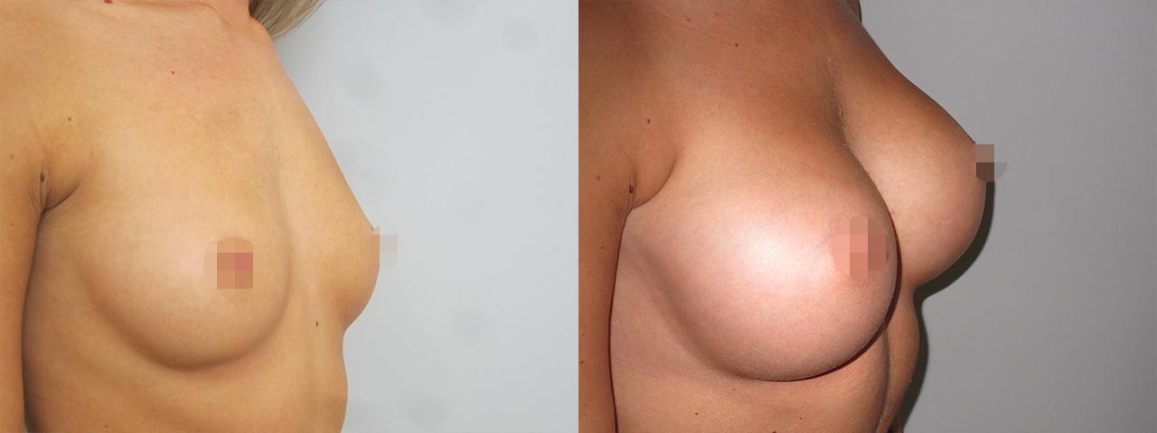 Zvětšení prsou implantáty