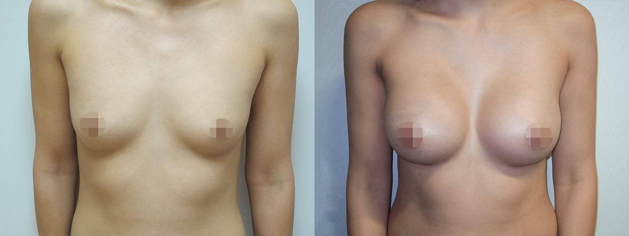 Zvětšení prsou implantáty
