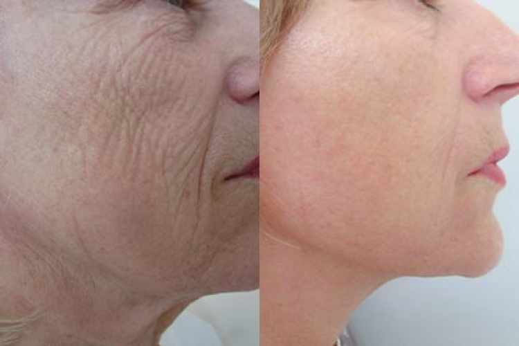 Fotogalerie - Facelift před a po