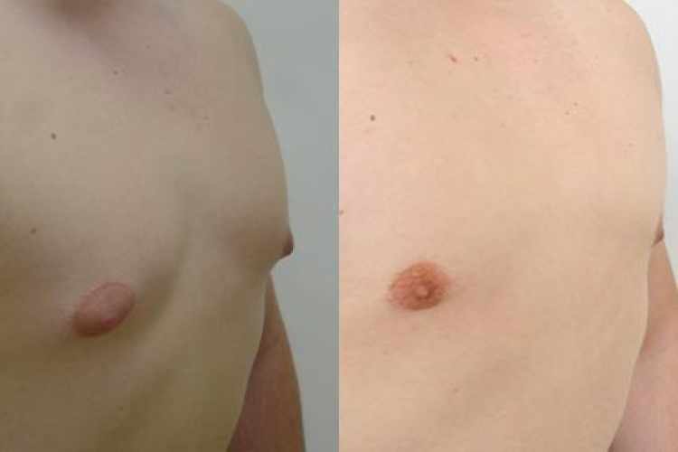 Gynekomastie před a po