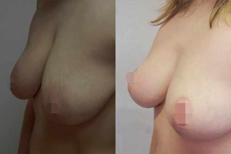 modelace prsou před a po