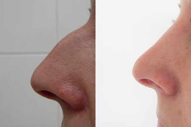 plastika nosu před a po