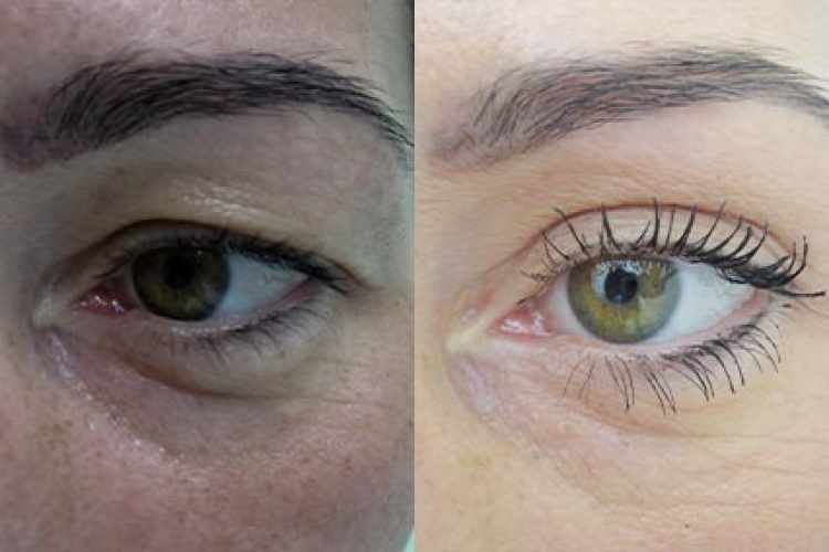 Operace očních víček před a po