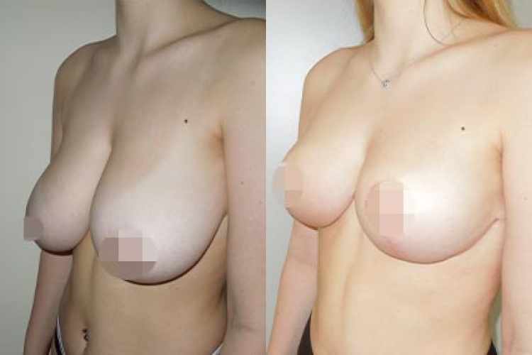 zmenšení prsou před a po