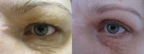 Operace očních víček před a po