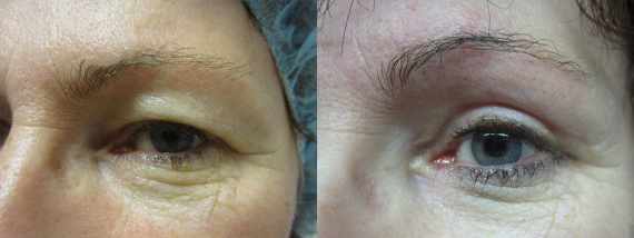 Operace očních víček před a po