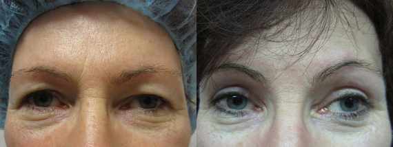 Operace očních víček před a po