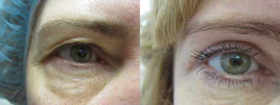 Operace očních víček před a po