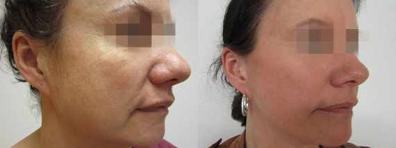 Fotogalerie - Facelift před a po