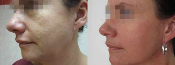 Fotogalerie - Facelift před a po