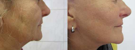 Fotogalerie - Facelift před a po