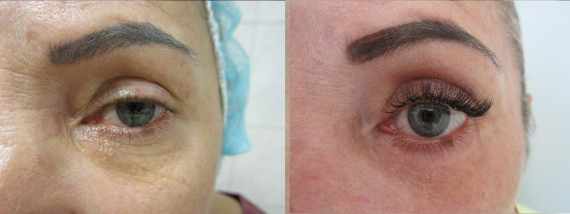 Fotogalerie - Operace očních víček před a po