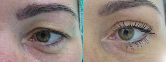 Fotogalerie - Operace očních víček před a po