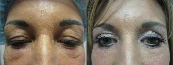 Fotogalerie - Operace očních víček před a po