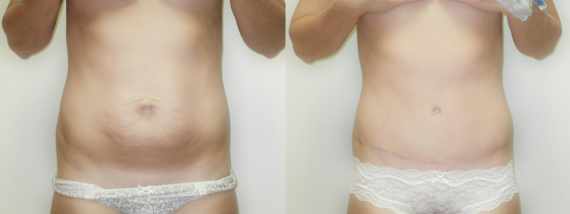 plastika břicha (Abdominoplastika) před a po