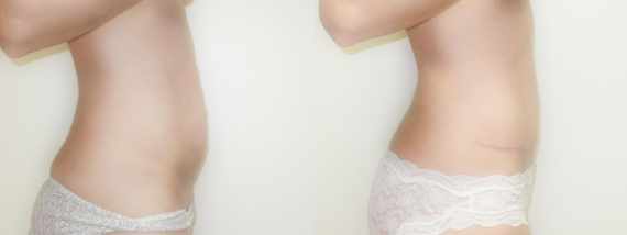 plastika břicha (Abdominoplastika) před a po