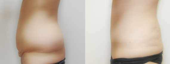 plastika břicha (Abdominoplastika) před a po