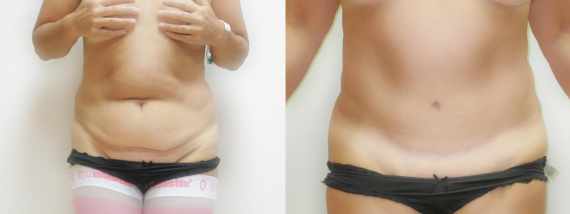 plastika břicha (Abdominoplastika) před a po