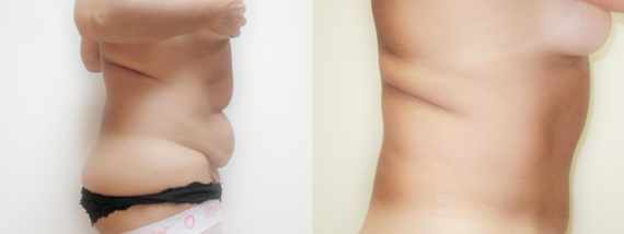 plastika břicha (Abdominoplastika) před a po
