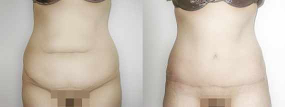 plastika břicha (Abdominoplastika) před a po