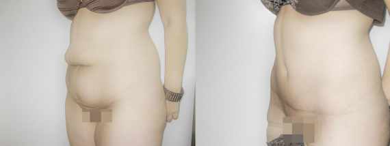 plastika břicha (Abdominoplastika) před a po