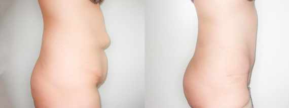 plastika břicha (Abdominoplastika) před a po