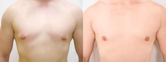 Před a po zmenšení prsou u mužů - gynekomastie