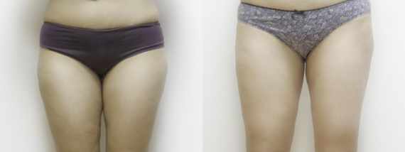 Liposukce před a po