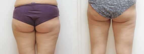 Liposukce před a po
