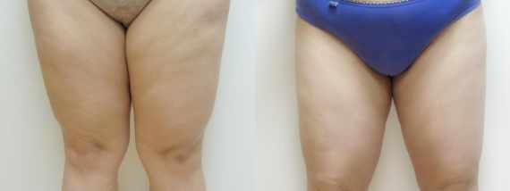 plastika břicha (Abdominoplastika) před a po