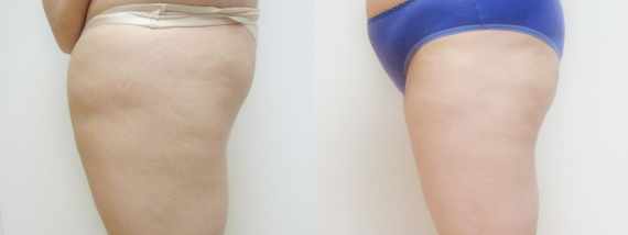 plastika břicha (Abdominoplastika) před a po