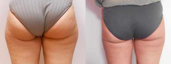 Liposukce vnějších stehen - fotogalerie před a po
