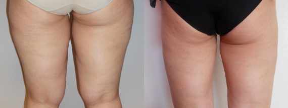 Liposukce vnějších stehen - fotogalerie před a po