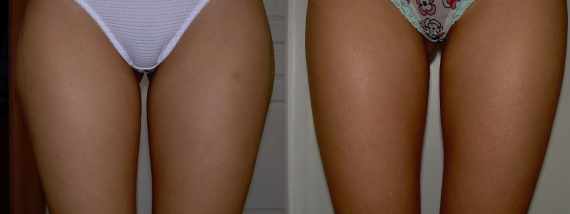 Liposukce vnějších stehen - fotogalerie před a po