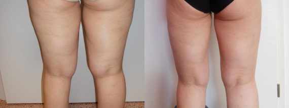 Liposukce vnějších stehen - fotogalerie před a po