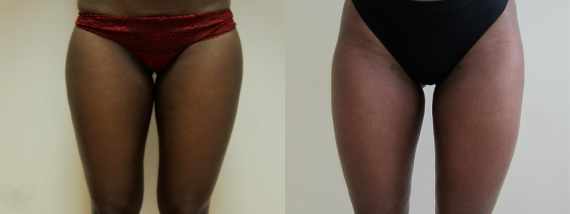 Liposukce před a po vnitřní stehna