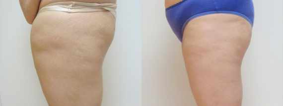 Liposukce vnějších stehen - fotogalerie před a po