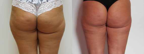 Liposukce vnějších stehen - fotogalerie před a po