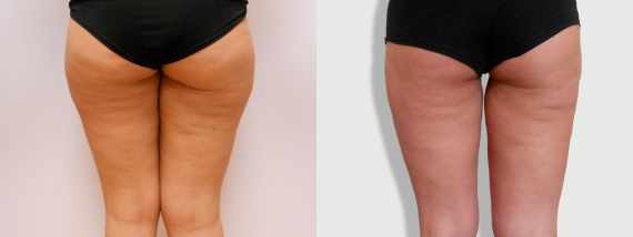 Liposukce vnějších stehen - fotogalerie před a po