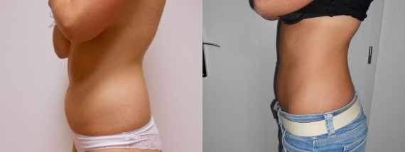 Foto před a po liposukce