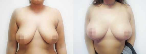 Fotogalerie - modelace prsou před a po