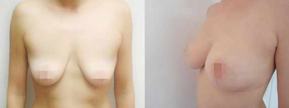 Fotogalerie - modelace prsou před a po