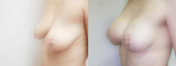 Fotogalerie - modelace prsou před a po