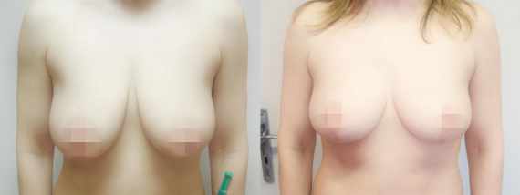 Fotogalerie - modelace prsou před a po